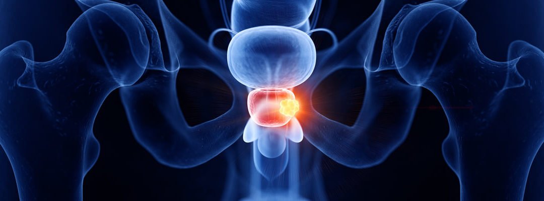 Día Mundial del Cáncer de Próstata: La detección precoz salva vidas y mejora tratamientos