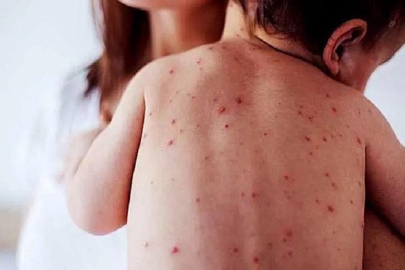 Nuevo caso de sarampión en Cochabamba eleva contagios a tres