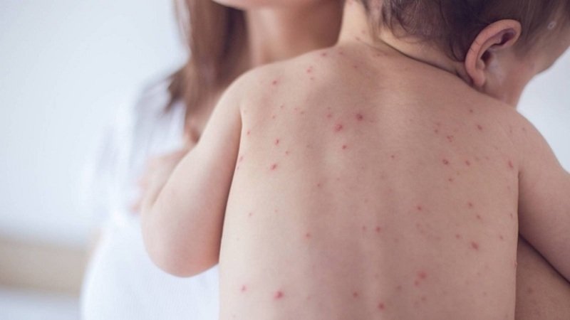 Tarija activa alerta sanitaria tras séptimo caso de sarampión y reporta baja cobertura de vacunación