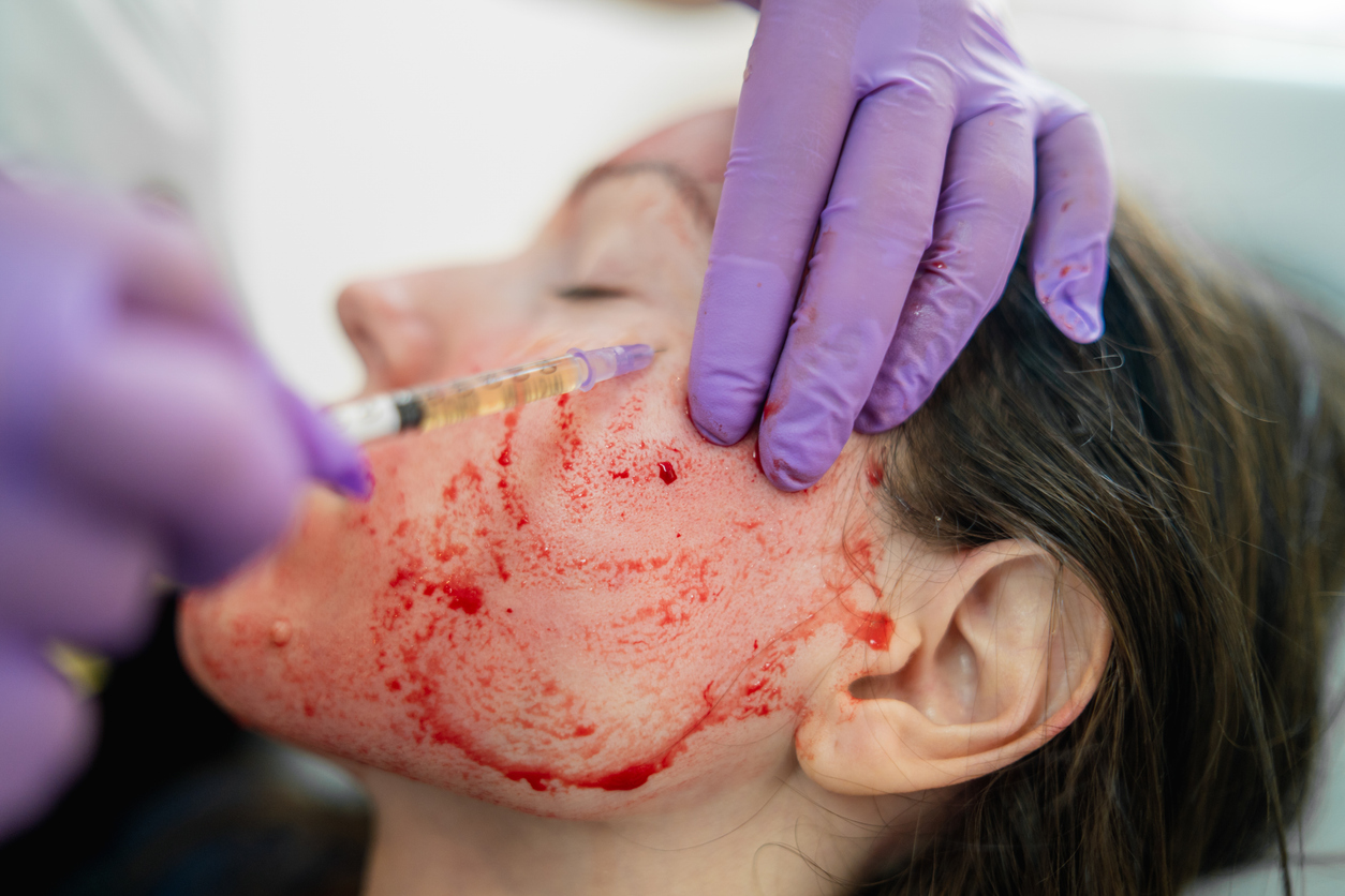 ¿Qué es el tratamiento facial PRP?
