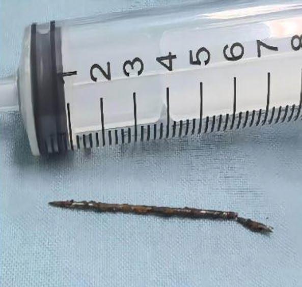 Los-medicos-estan-confundidos-despues-de-encontrar-impactantes-cuerpos-extranos.jpg